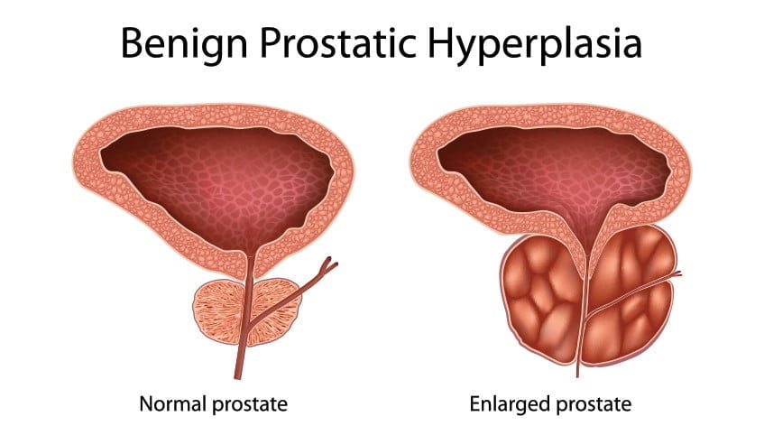 case study 70 benign prostatic hyperplasia