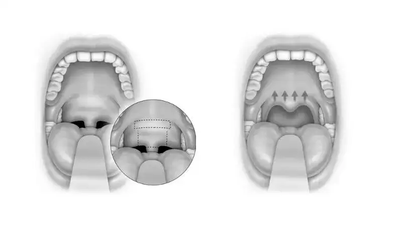 Anterior Palatoplasty-The Palatal Lift Operation