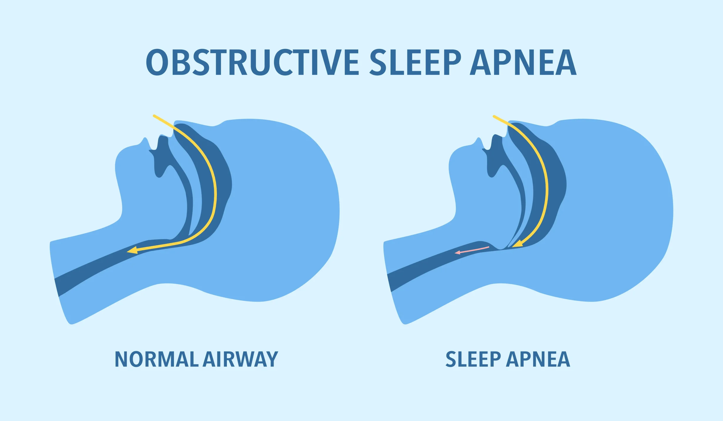 obstructive sleep apnea, normal airway, sleep apnea, diagram